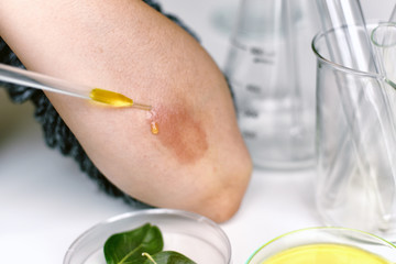 Skin allergy diseases problem, Female dermatology patient with allergic eczema rash on arm, Allergen dermatitis testing, Natural plant herbal extract.