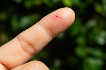Woman has been cut index finger and scar skin on hand, Close up & Macro shot, Asian Body skin part, Healthcare concept, Bokeh green garden background