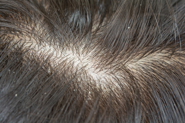 Scalp and dandruff Skin problems and itching