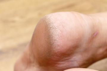 Corn callus cracks on a sole heel foot close up. Dry skin dermatology problem.