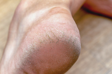 Fototapeta premium Corn callus cracks on a sole heel foot close up. Dry skin dermatology problem.