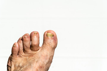 Fungus on toenail plate. Nail plates of toes are disfigured by fungus. Fungus on toenails. Nail...