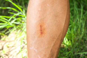 Old scar on man's leg. Accident in the past.