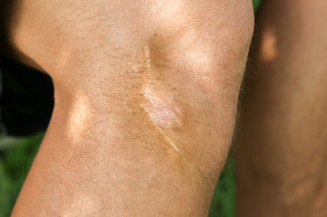 Naklejka premium Old scar on man's leg. Accident in the past.