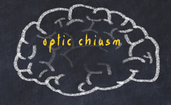 Drawind Of Human Brain On Chalkboard With Inscription Optic Chiasm