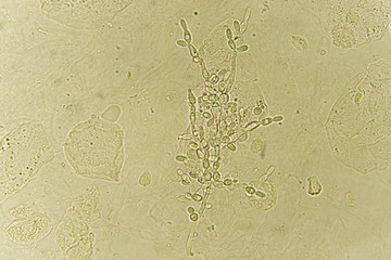 Pseudohyphae and budding yeast cells in patient urine (urinary tract infections), analyze by microscope