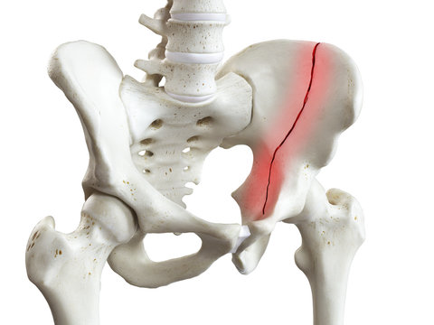 3d rendered medically accurate illustration of a broken pelvis