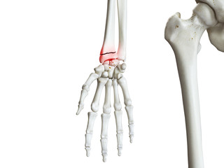 3d rendered medically accurate illustration of a broken wrist