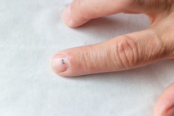 Index finger with subungual hematoma. - 284875004