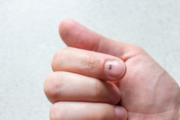 Index finger with subungual hematoma. - 284875059