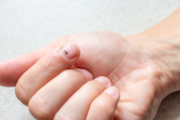 Index finger with subungual hematoma. - 284875068
