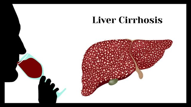 Cirrhosis. Violation of liver structure.