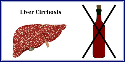 Cirrhosis. Violation of liver structure.