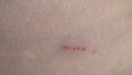 scratch scar on arm