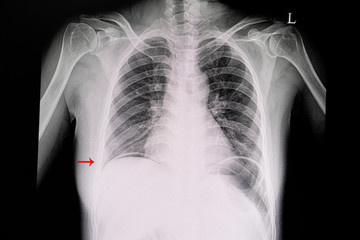 Chest xray of a patient showing free air in the abdominal cavity