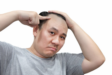 Close up of serious Asian bald man alopecia pointing his head isolated on white background. Human hair loss solution concept.