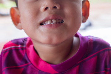 close up boy smiling tooth caries. the concept of dental and oral health of children and toothpaste.