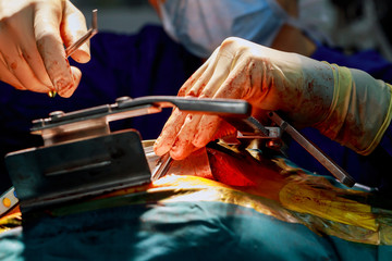 Heart surgery. Open heart surgery suture greater saphenous vein