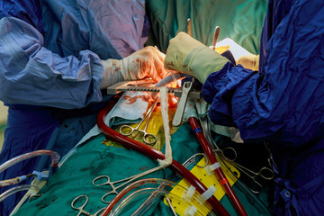 Surgery for coronary artery disease using off-pump technique