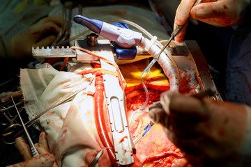 A surgeon performs coronary artery bypass grafting open heart surgery.