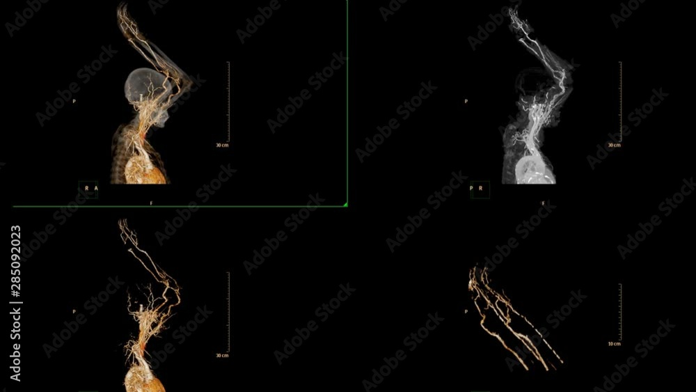 Poster multi view of cta brachial artery or ct scan of upper extremity 3d rendering image for diagnosis bra