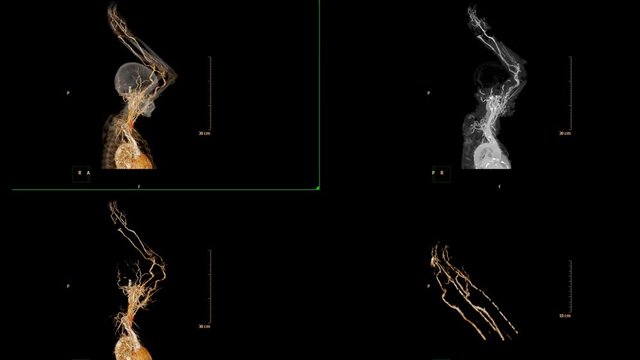 Multi VIEW of CTA brachial artery or CT scan of upper extremity 3d rendering image  for diagnosis brachial artery stenosis .