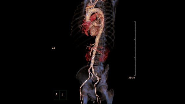 CTA Abdominal Aorta 3D rendering image  turn around on the screen for diagnostic aortic aneurysm .