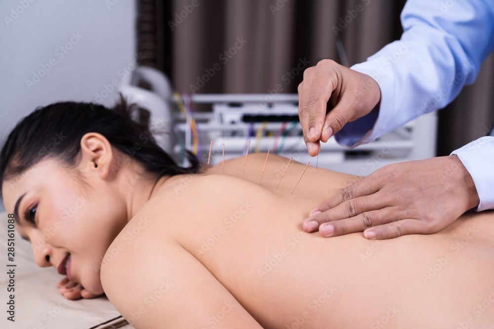 Sticker woman undergoing acupuncture treatment on back