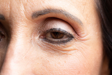 Close up of woman face showing eye affected of drooping eyelid after botox treatment