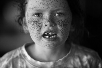 Freckle Face