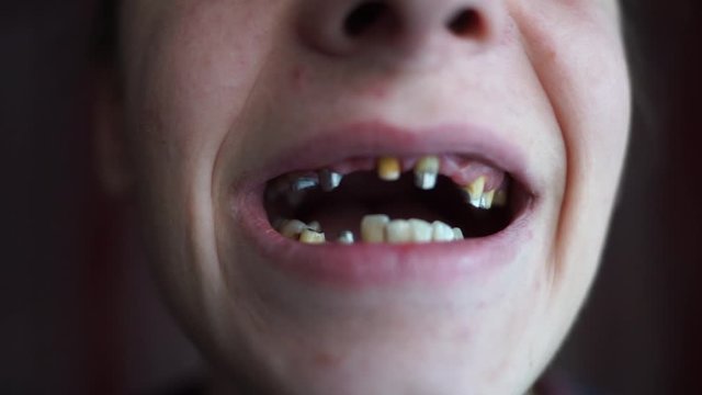 A man with very bad teeth. Diseases of teeth and gums. Toothless young man. Preparation of teeth for prosthetics. Dentistry.