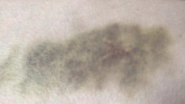 Video close-up of a large 1 week bruise and hematoma on the skin of the hip of a woman. The concept of pain close-up