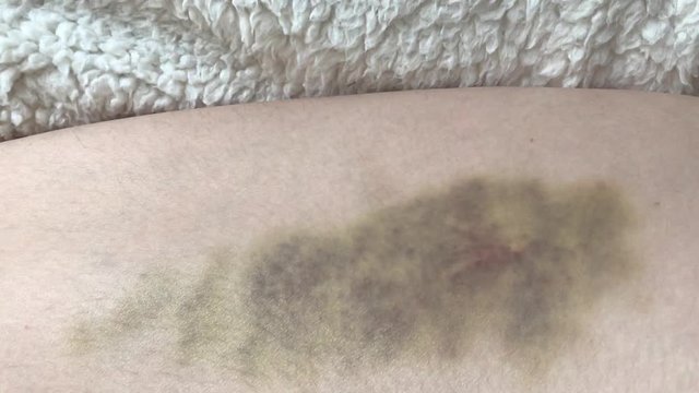 Video close-up of a large bruise and hematoma on the skin of the hip of a woman. The concept of pain close-up