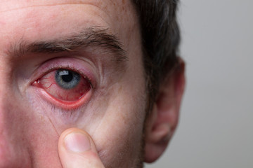 Close up of a severe bloodshot eye. Blepharitis, Conjunctivitis condition