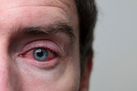 Close up of a severe bloodshot eye. Blepharitis, Conjunctivitis condition