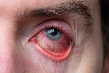Close up of a severe bloodshot eye. Blepharitis, Conjunctivitis condition