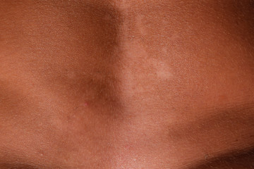 Sunburn on the skin of the stomach. Exfoliation, skin peels off. Dangerous sun tan