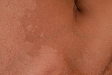 Fototapeta premium Sunburn on the skin of the shoulders. Exfoliation, skin peels off. Dangerous sun tan