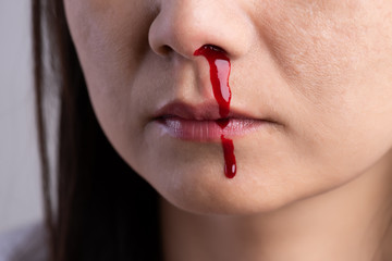 Nosebleed , a young woman with a bloody nose. Healthcare and medical concept.