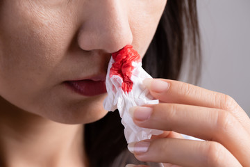 Nosebleed , a young woman suffering from nose bleeding and using tissue paper for stop bleeding....