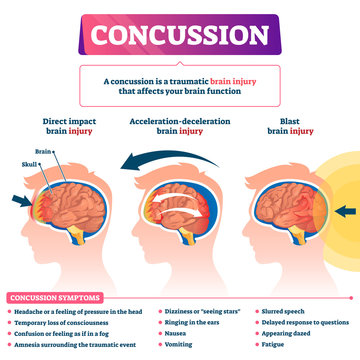 Concussion vector illustration. Labeled educational post head trauma scheme