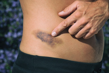 Detail of big bruise on man body
