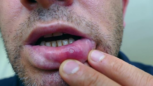 man with aphthae on lip. thrush, canker sores in the oral cavity of people,
