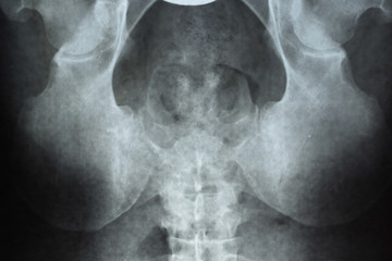 X-ray of the pelvis and sacrum. X-ray