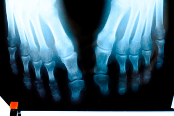 X-ray of toes. Foot on Xray. bone research