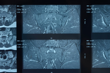 MRI sacroiliac articulation. Study of ankylosing spondyloarthritis patient.