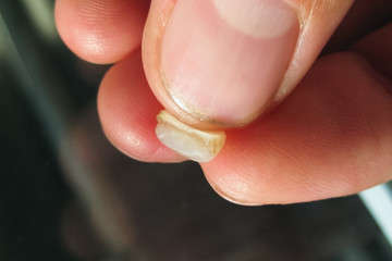 Fallen off old filling with a cutter. The seal of the tooth.
