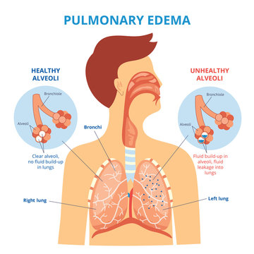 Pulmonary Edema - Respiratory Lung Disease Infographic With Flat Cartoon Man Drawing Showing His Internal Organs