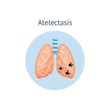 Atelectasis a medical scheme of lung disease vector illustration isolated.