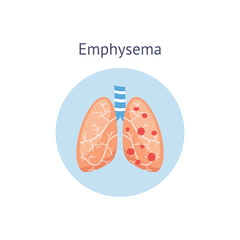 Emphysema chronic pulmonary disease diagram vector illustration isolated.